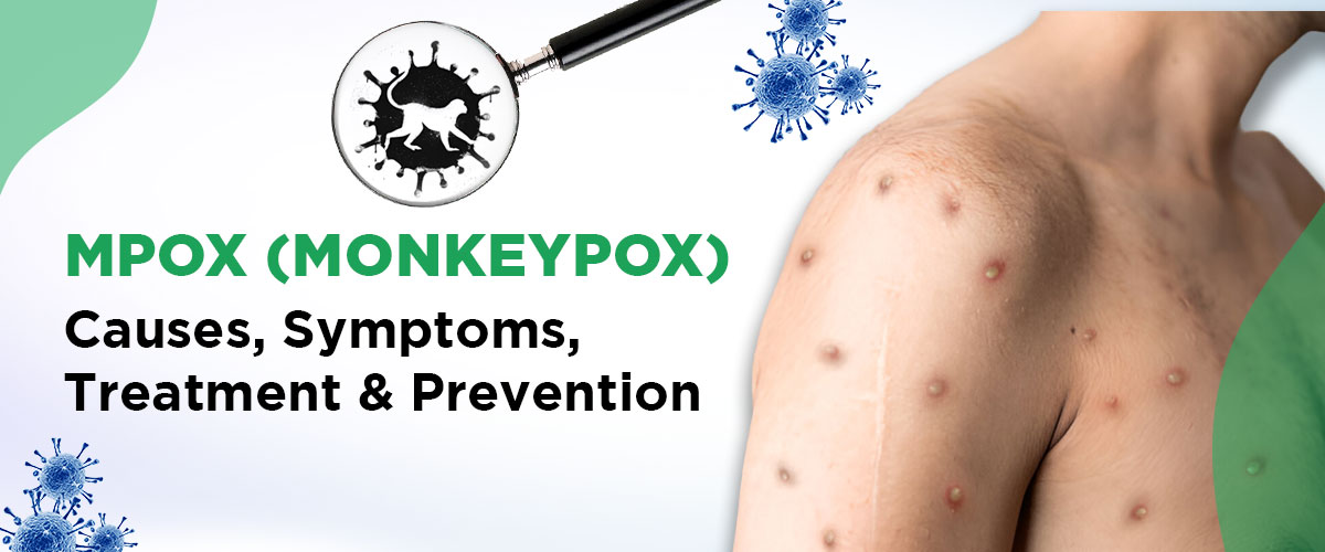 Monkeypox Virus: Symptoms, Causes & Prevention