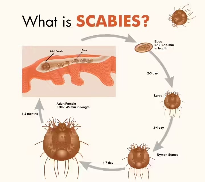 Scabies: Causes, Symptoms, Treatment & Prevention